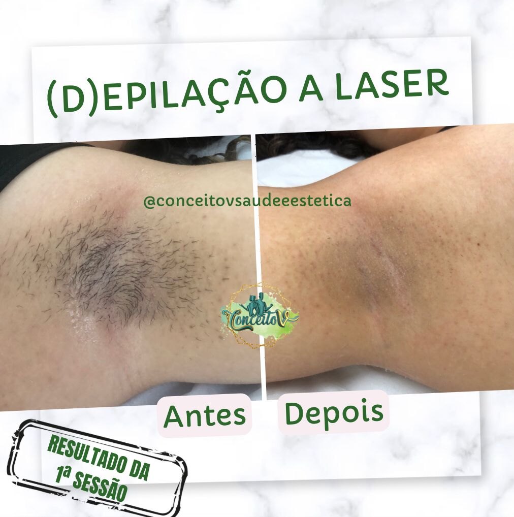 Resultado real de depilação a laser publicado pela clínica